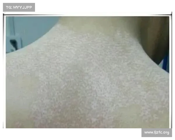 辐射导致的皮肤白斑治疗攻略 辐射导致的皮肤白斑治疗攻略